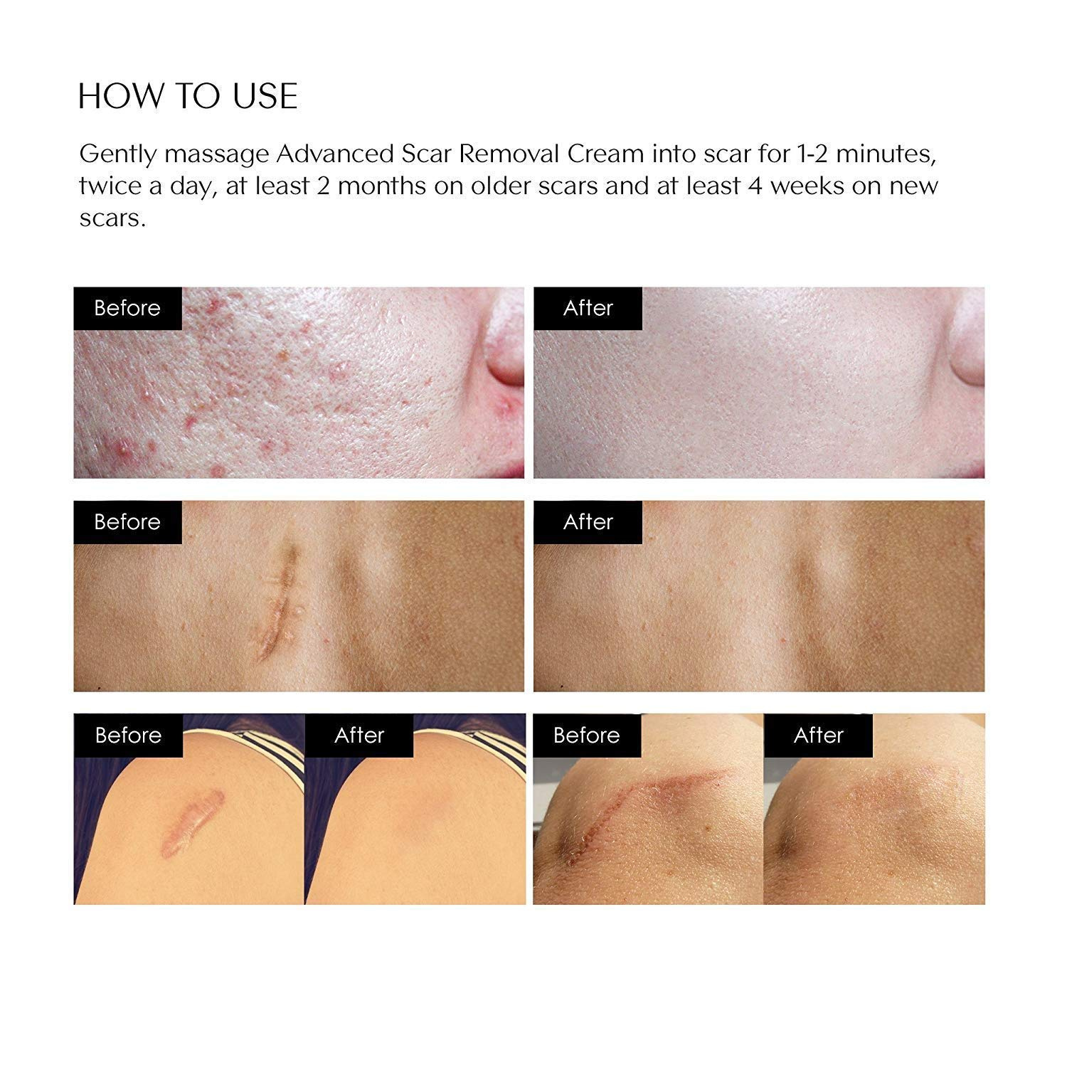 Puriderma Scar Removal Cream - Advanced