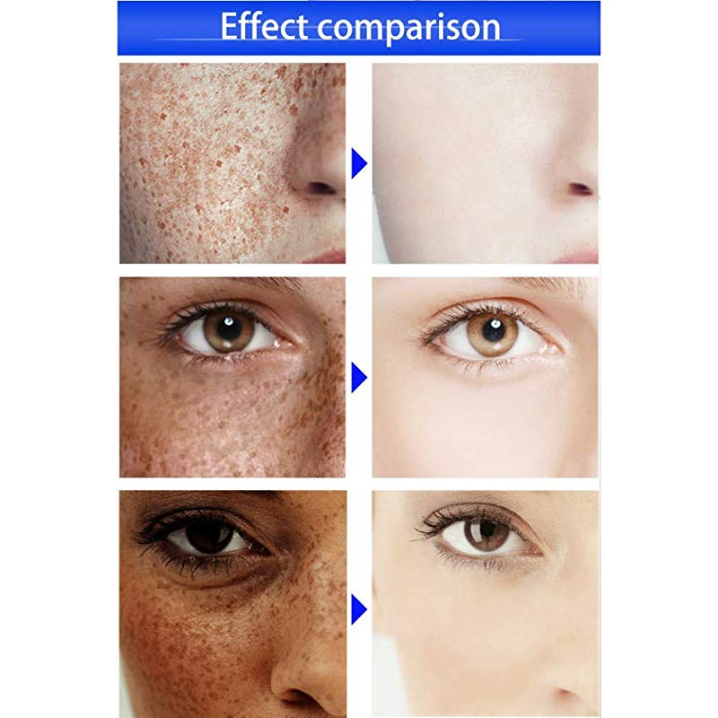 Allbestaye Whitening Cream Face Freckles Removal Cream Dark Spots Cream Against Pigment Spots Age Hyperpigmentation By Allbestaye Shop Online For Beauty In New Zealand